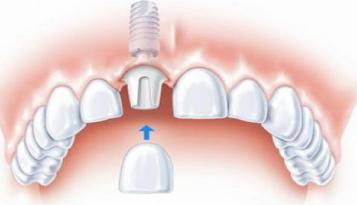 種植牙的(de)背後有(yǒu)多(duō)少(shǎo)秘密?
