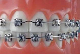 托槽脫落怎麽補救?不(bù)及時(shí)處理(lǐ),牙套還(hái)得(de)多(duō)帶一(yī)年(nián)!