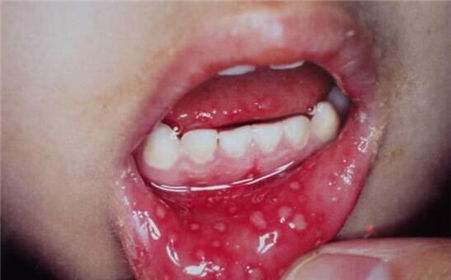 當牙套遇上(shàng)口腔潰瘍,注定是(shì)悲劇(jù)收場(chǎng)麽?